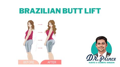 Brazilian Butt Lift Surgery in Miami, FL 